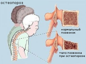 Нормальный позвонок и позвонок при остеопорозе