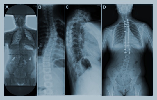 Рентгеновские снимки при кифосколиозе до и после операции
